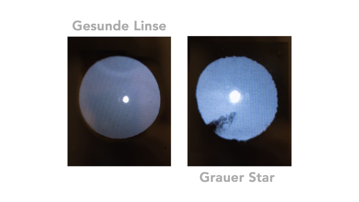Augenoptiker bei der Linsendurchlässigkeits-Messung zur Erkennung des Grauen Stars